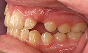 gallery-patient-45c-before-right