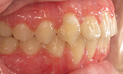 gallery-patient-46c-after-left