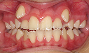 gallery-patient-46c-before-center