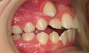 gallery-patient-46c-before-left