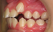 gallery-patient-46c-before-right