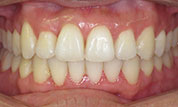 gallery-patient47-after-center