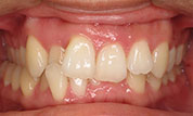 gallery-patient47-before-center