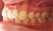 gallery-patient47-before-right