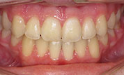gallery-patient48-after-center