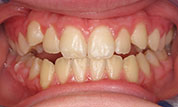 gallery-patient48-before-center