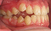 gallery-patient48-before-left